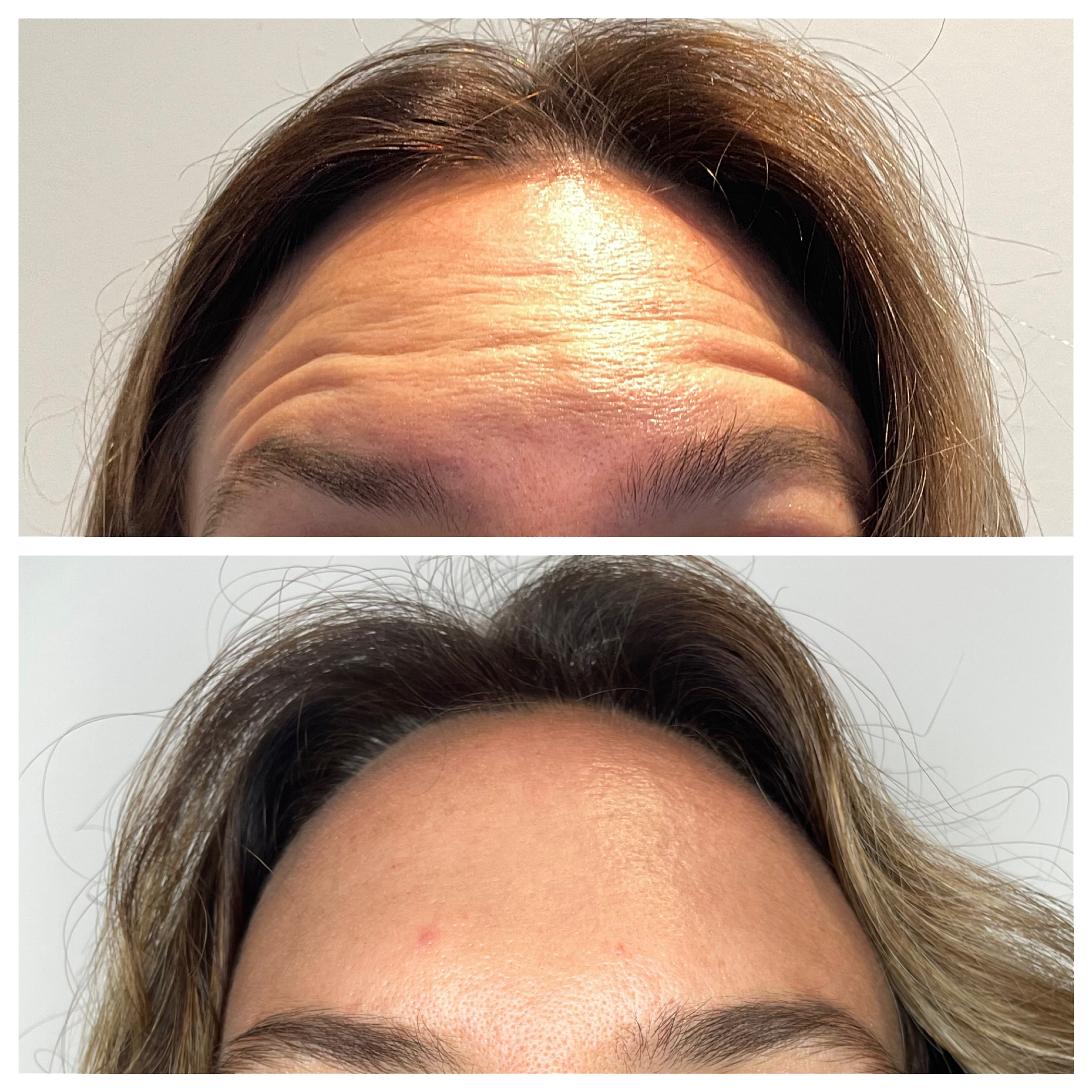 Before and after Botox treatment showing wrinkle reduction at Neat Studio