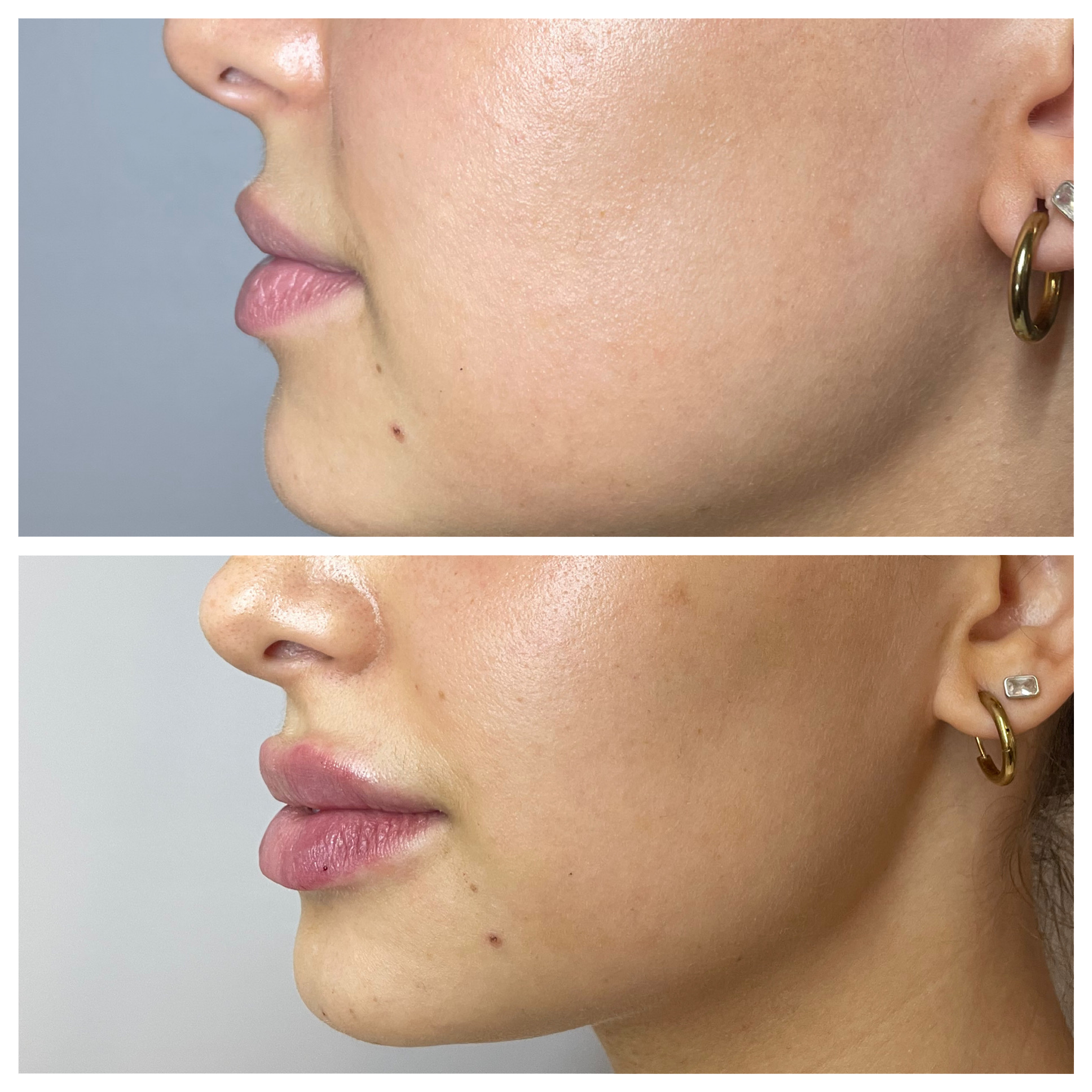 Satisfied client showing before and after results of their lip filler treatment at Neat Studio