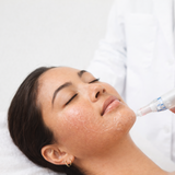 Microneedling